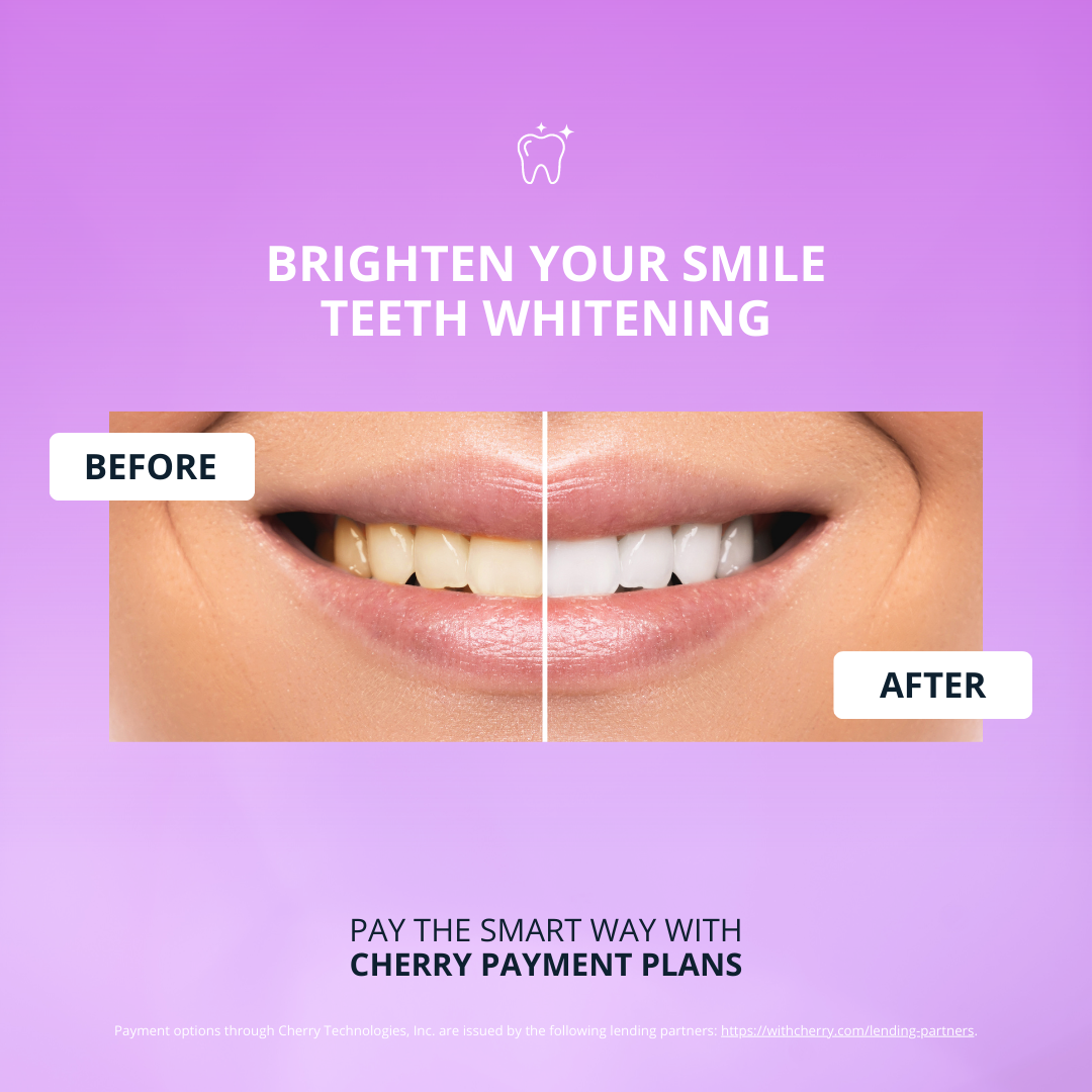 Veneers-2